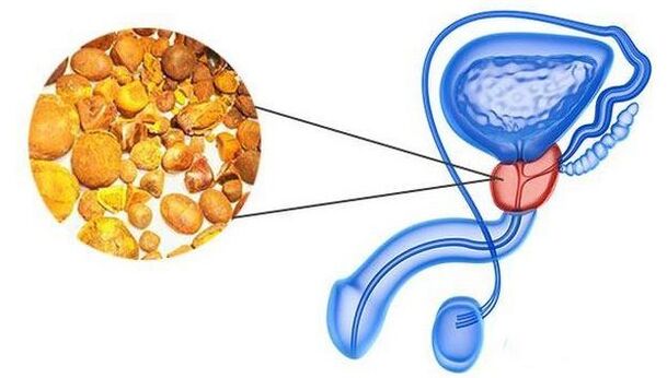 Calculator in a prostate