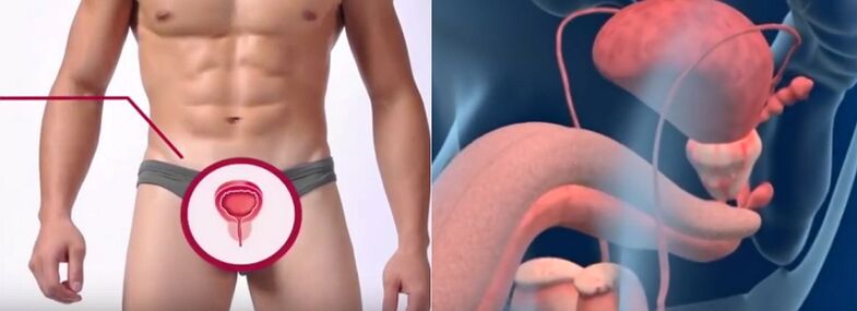 Prostatitis in men, recognizable by certain signs