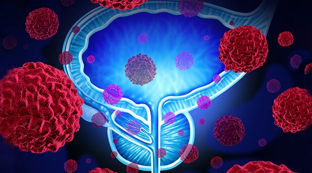 bacteria as causes of prostatitis