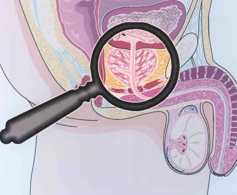 Defeat of prostate tissue in patients with chronic prostatitis in men